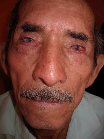 A Guatemalan man with severe pterygia.